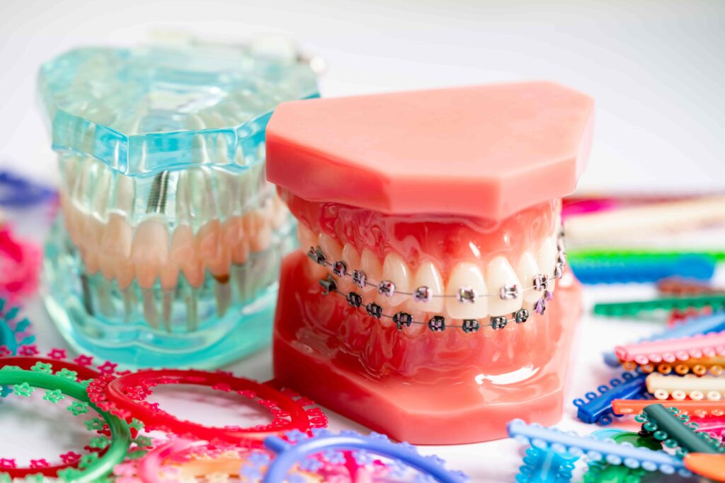 Dental models showing clear aligners and metal braces with colorful orthodontic bands