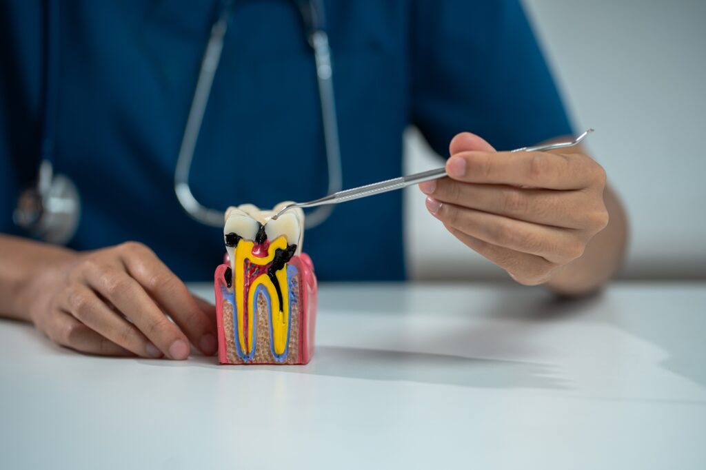 Dentist using a model to explain root canal treatment
