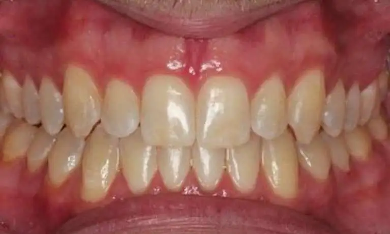Straightened teeth after an orthodontic treatment with clear braces
