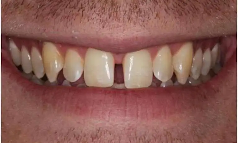 Crooked teeth before being straightened with Invisalign clear braces